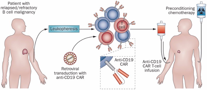 CAR-T治疗综述CD19抗原